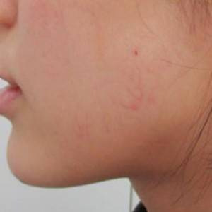 蚌埠韩美美莱整形医院医生张涛做玻尿酸垫下巴怎么样？来看案例效果图