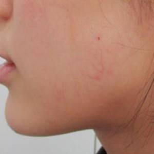 蚌埠韩美美莱整形医院医生张涛做玻尿酸垫下巴怎么样？来看案例效果图