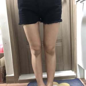 贵阳华美整形美容医院医生田永华做大腿吸脂效果怎么样？附大腿吸脂案例前后对比图