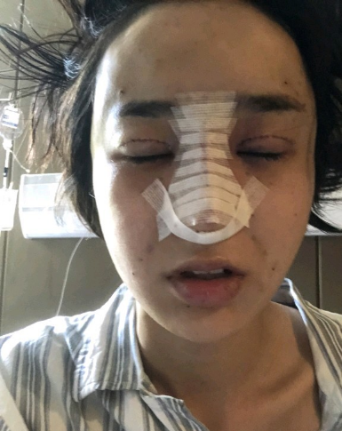 武汉米兰医疗美容医生柳再亿做眼综合+鼻综合整形怎么样？附真实案例对比图