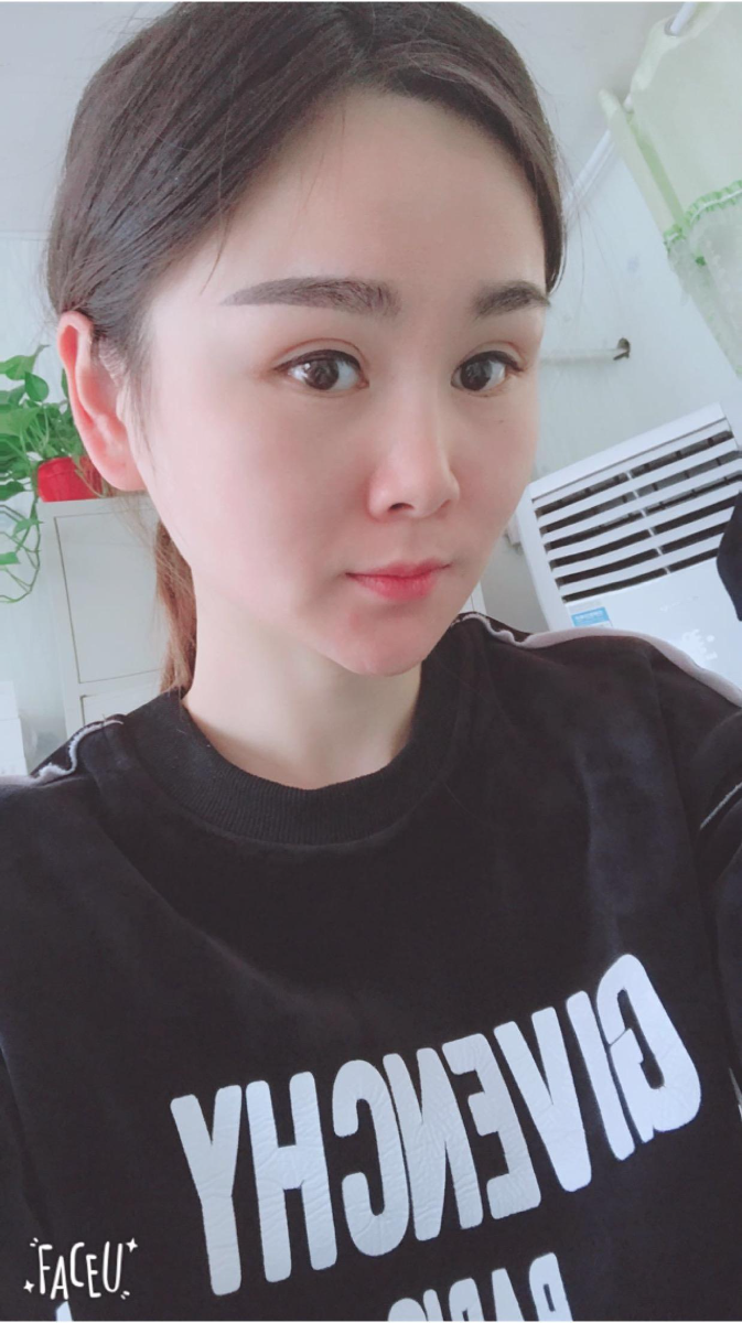 北京彤美美容整形医院医生杨晓惠做颧骨内推+面部吸脂手术效果怎么样？附案例