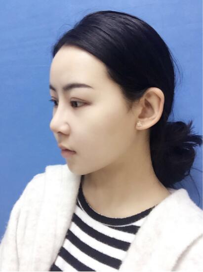 上海时光整形外科医院医生李静林做假体隆鼻和反颌手术怎么样？