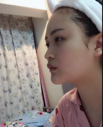 北京伊美尔美容爱康医院医生柳成做鼻综合整形怎么样？附案例效果图