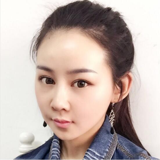 上海时光整形外科医院医生李静林做假体隆鼻和反颌手术怎么样？