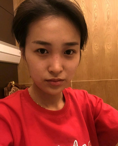 武汉米兰医疗美容医生柳再亿做眼综合+鼻综合整形怎么样？附真实案例对比图