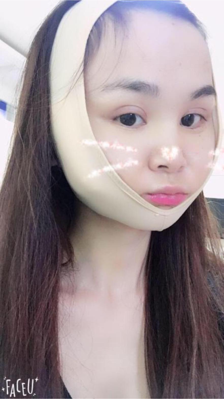 北京彤美美容整形医院医生杨晓惠做颧骨内推+面部吸脂手术效果怎么样？附案例