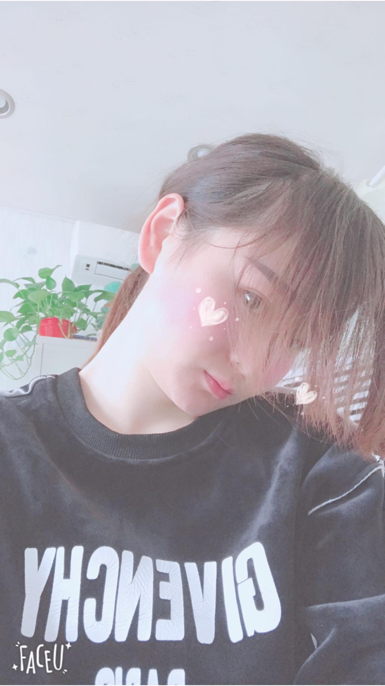 北京彤美美容整形医院医生杨晓惠做颧骨内推+面部吸脂手术效果怎么样？附案例