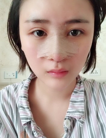 北京伊美尔美容爱康医院医生柳成做鼻综合整形怎么样？附案例效果图