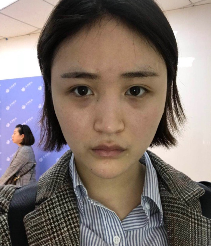 北京伊美尔美容爱康医院医生柳成做鼻综合整形怎么样？附案例效果图