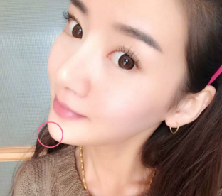 阜阳市人民医院吸脂瘦脸
