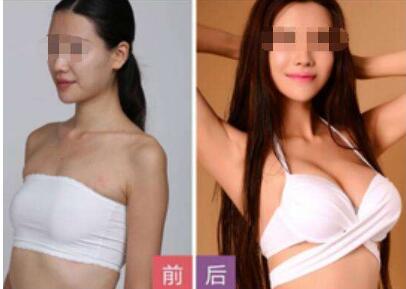 成都魅丽经纬整形美容医院假体隆胸