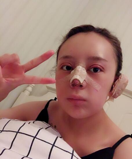 上海时光整形外科医院双眼皮+隆鼻+下颌角案例