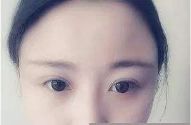 郑州集美美容医院自体脂肪那丰太阳穴