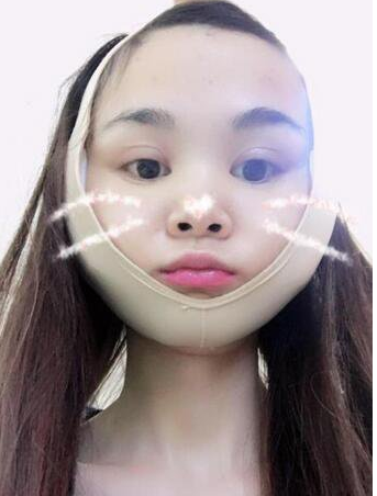 上海时光整形医生何晋龙做下颌角磨骨术前术后案例效果对比图