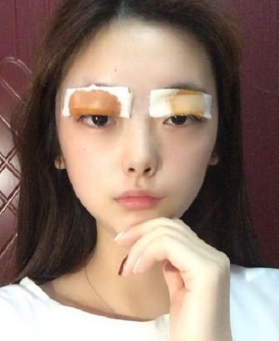 合肥韩美整形医院做双眼皮效果怎么样?附石显武医生案例