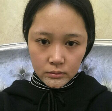 上海时光整形医院做丰下巴怎么样？许黎平医生丰下巴案例分享