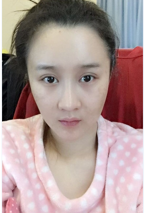 上海时光整形医院自体脂肪填充脸部真实效果图分享