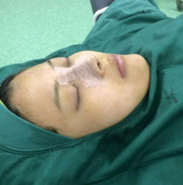 合肥韩美整形医院做隆鼻手术效果怎么样?附刘冷医生隆鼻案例效果图