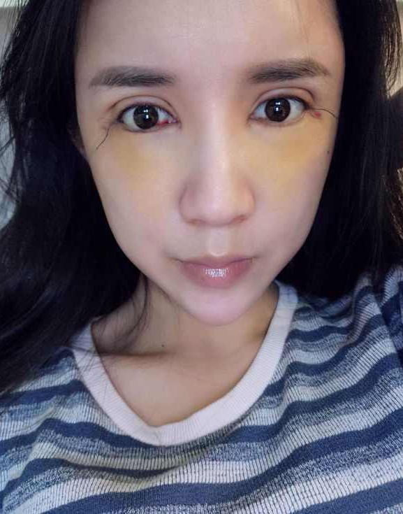 上海时光整形医院张晶医生做开眼角怎么样？附真实效果图