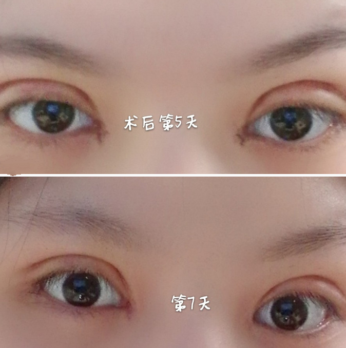 双眼皮案例效果对比照