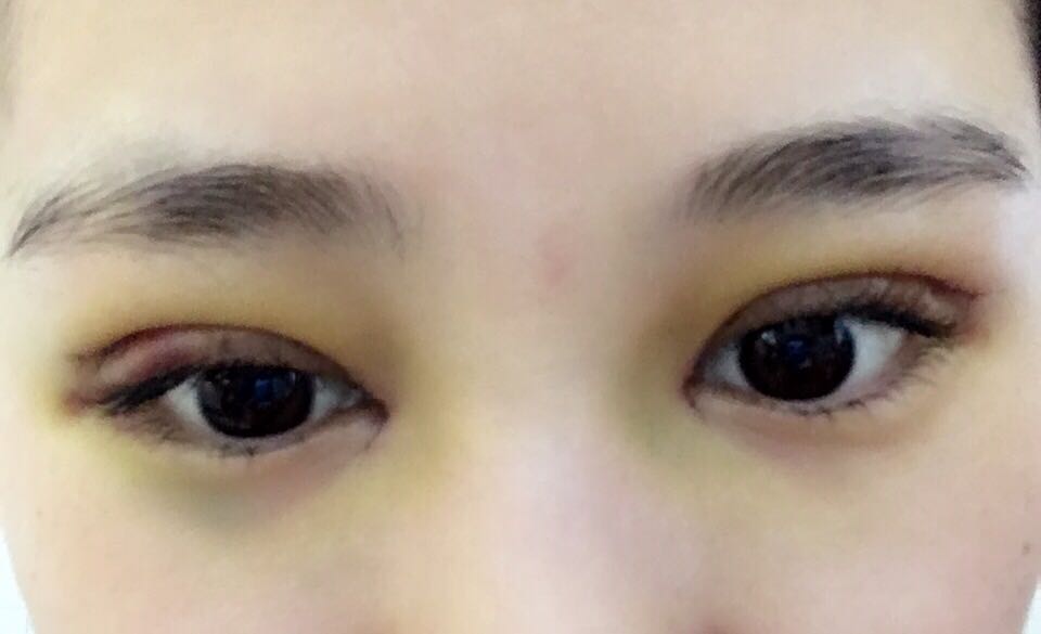 蚌埠韩美美莱整形医生郑捷做开眼角怎么样？附案例效果图