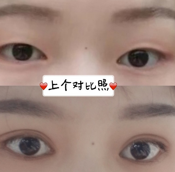 鞍山菲之都医疗整形医院做开眼角+全切双眼皮效果怎么样？附蔺娇婷医生案例
