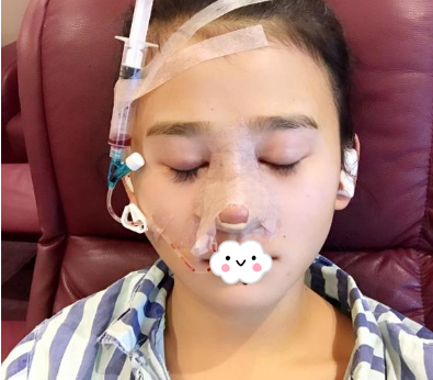 蚌埠韩美美莱整形医生历芳做耳软骨隆鼻怎么样？附耳软骨隆鼻案例对比图