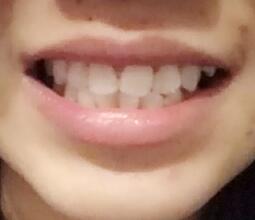 鞍山时代口腔门诊部刘昕医生做美容冠效果怎么样？一起来看看吧