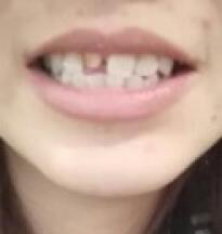 鞍山时代口腔门诊部刘昕医生做美容冠效果怎么样？一起来看看吧