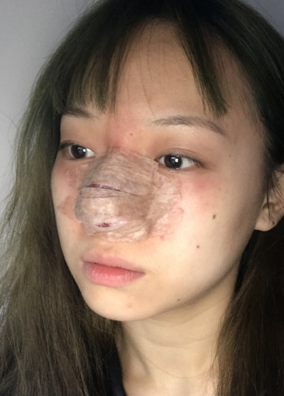 周娜医生缩鼻头案例效果图