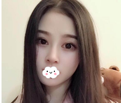 蚌埠韩美美莱整形医生历芳做耳软骨隆鼻怎么样？附耳软骨隆鼻案例对比图