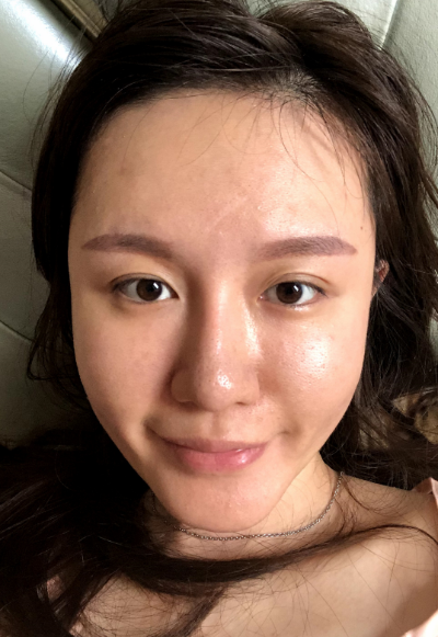 蚌埠韩美美莱整形医生张燕做自体脂肪丰面颊效果怎么样？附案例效果图