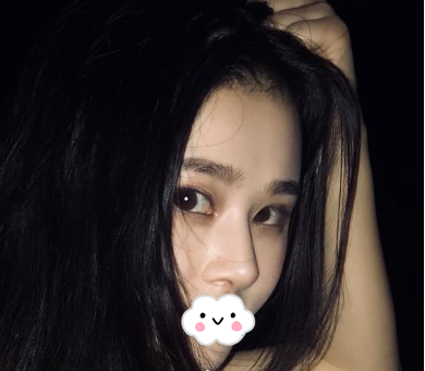 蚌埠韩美美莱整形医生历芳做耳软骨隆鼻怎么样？附耳软骨隆鼻案例对比图