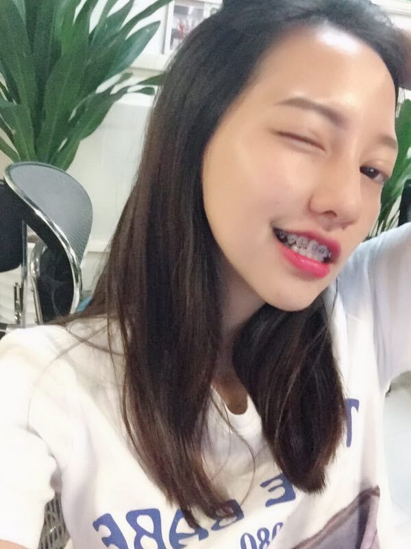 巴中华医口腔医院做牙齿矫正效果好吗？附母汶灵医生牙齿矫正案例效果图