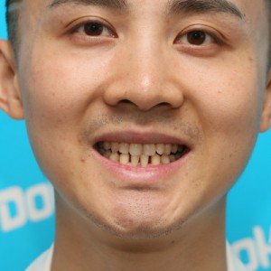 鞍山时代口腔门诊部做瓷贴面案例效果图