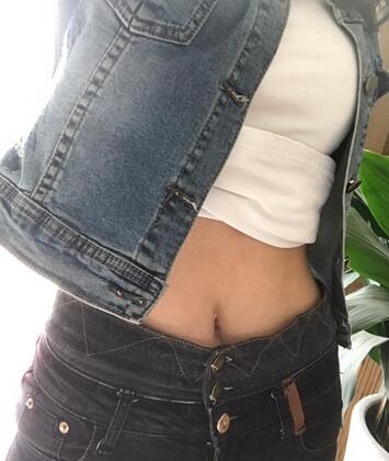 保定现代女子医院整形美容中心做腰腹部吸脂怎么样？附林秀莲医生案例效果图
