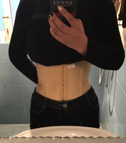 保定现代女子医院整形美容中心做腰腹部吸脂怎么样？附林秀莲医生案例效果图