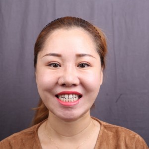 保定东阳口腔医院赵晨医生做瓷贴面怎么样?附瓷贴面案例效果对比图