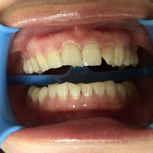 保定东阳口腔医院王增光医生做牙齿美白怎么样？附牙齿美白案例效果对比图