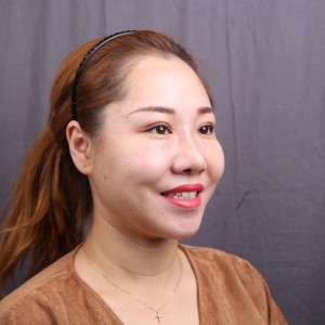 保定东阳口腔医院赵晨医生做瓷贴面怎么样?附瓷贴面案例效果对比图