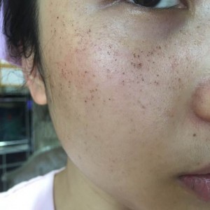 宝鸡皮肤病医院文东亮医生做脸部祛斑效果怎么样？附脸部祛斑案例