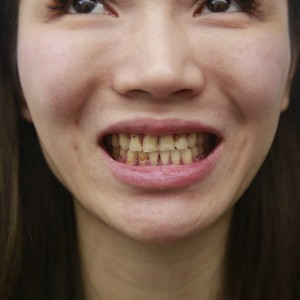 保定东阳口腔医院兴磊医生做牙齿贴面怎么样？附牙齿贴面案例效果对比图
