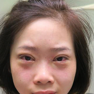 保定安卓贝拉医疗美容门诊部孙大山医生做双眼皮+去眼袋怎么样？附案例效果对比图