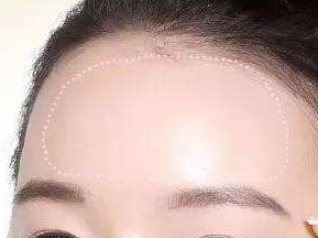 贵阳利美康医院自体脂肪丰额头