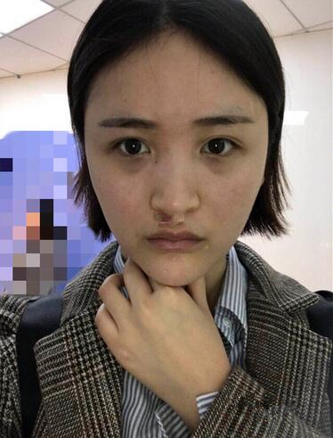 苏州爱思特医疗美容医院自体脂肪隆鼻手术前效果