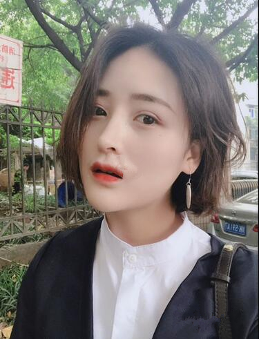 苏州爱思特医疗美容医院自体脂肪隆鼻手术后效果