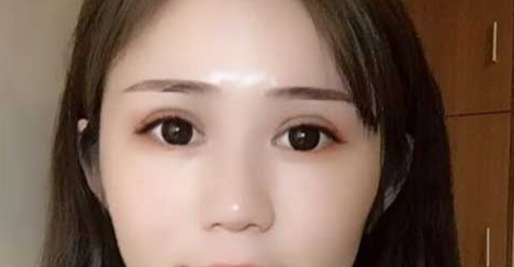 全切双眼皮消肿的办法有哪些？