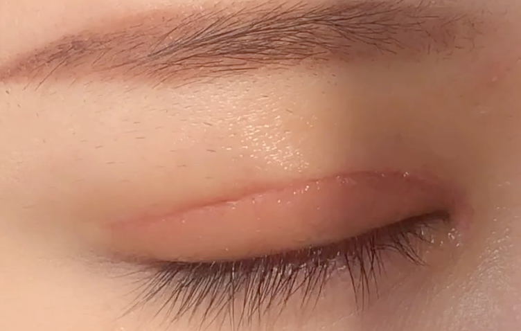 全切双眼皮多久恢复？全切开双眼皮有哪些优点？