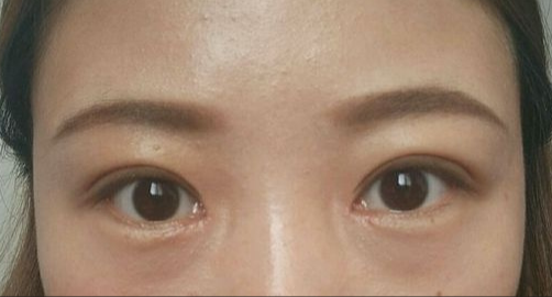 全切双眼皮能保持多久？