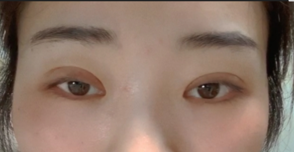 什么是全切双眼皮？全切双眼皮的恢复时间？